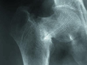 Dėl osteoporozės įvykęs dažniausiai pasitaikantis šlaunikaulio kaklo lūžimas