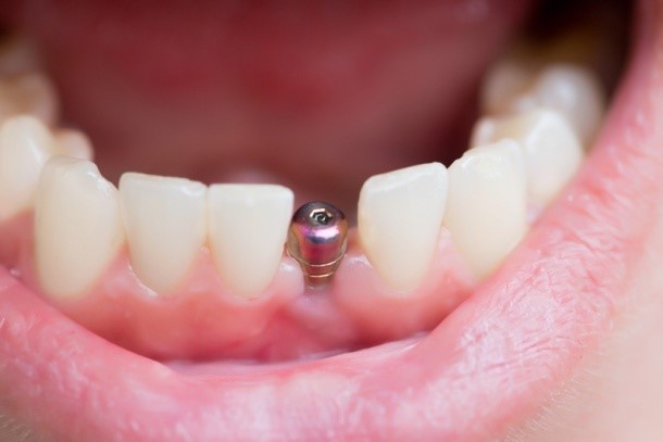 Dantų implantavimas | rengėjų nuotr.