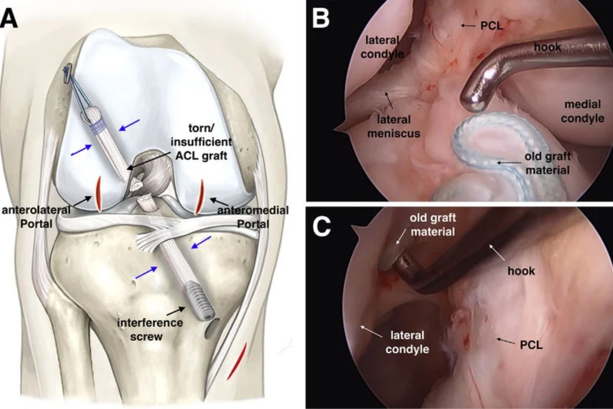 Sąnario implantas
