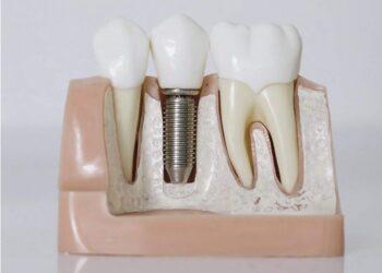 Danties implantas | sosklinika.lt nuotr.